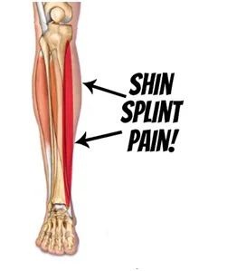 Do I have stress fractures?